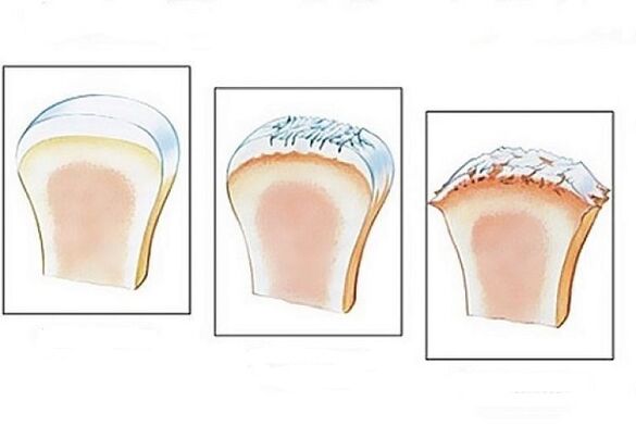 Joint damage at different stages of the development of osteoarthritis. 