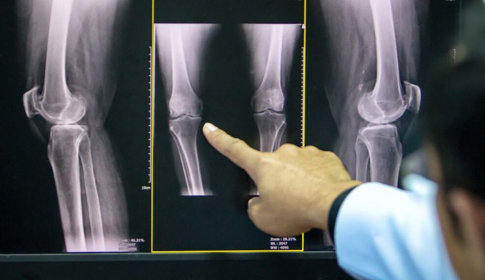 osteoarthritis of the knee x-ray