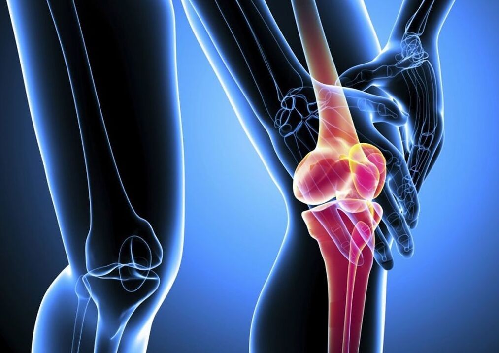 Pain during physical activity in osteoarthritis of the knee joint