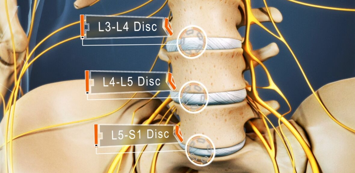 Discs of the lumbar spine, which are most often affected in osteochondrosis. 