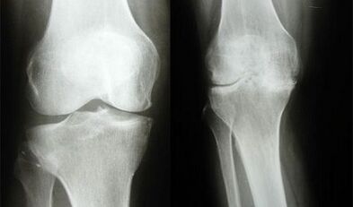 Knee diagnostic methods