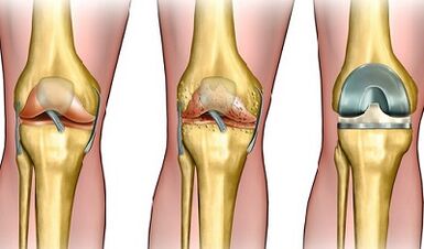 The degree of development of the osteoarthritis of the knee joint