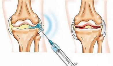 The knee joint lock for osteoarthritis