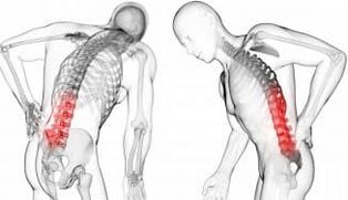 Intervertebral hernia complication with osteochondrosis