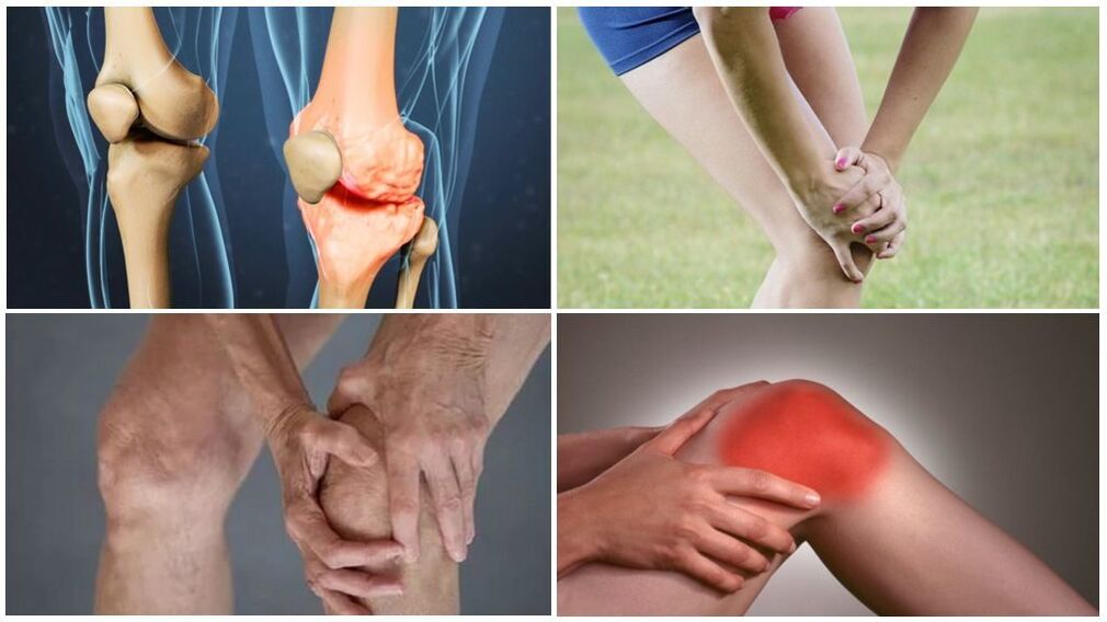 Stages of osteoarthritis