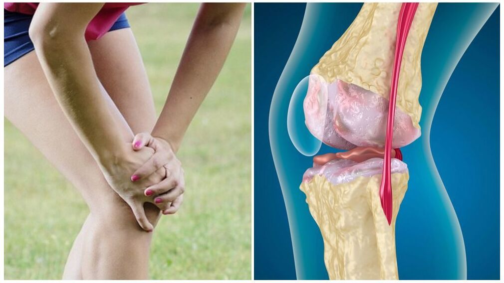 Symptoms of osteoarthritis