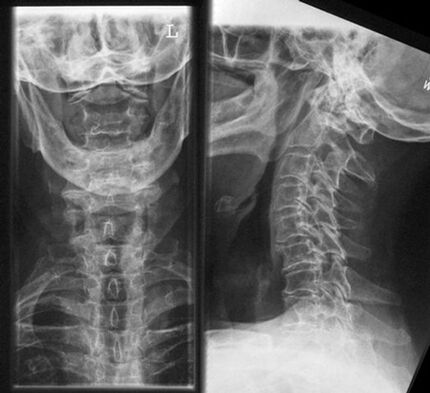 Cervical X -Ray - Diagnostic Method of Osteochondrosis