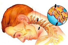 Nerve pinch in the column with cervical osteochondrosis