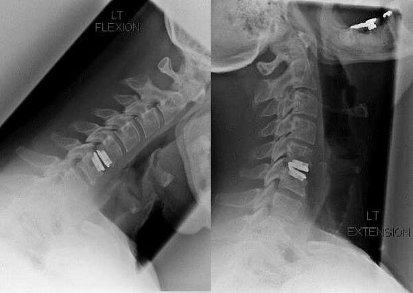 spine image after surgery