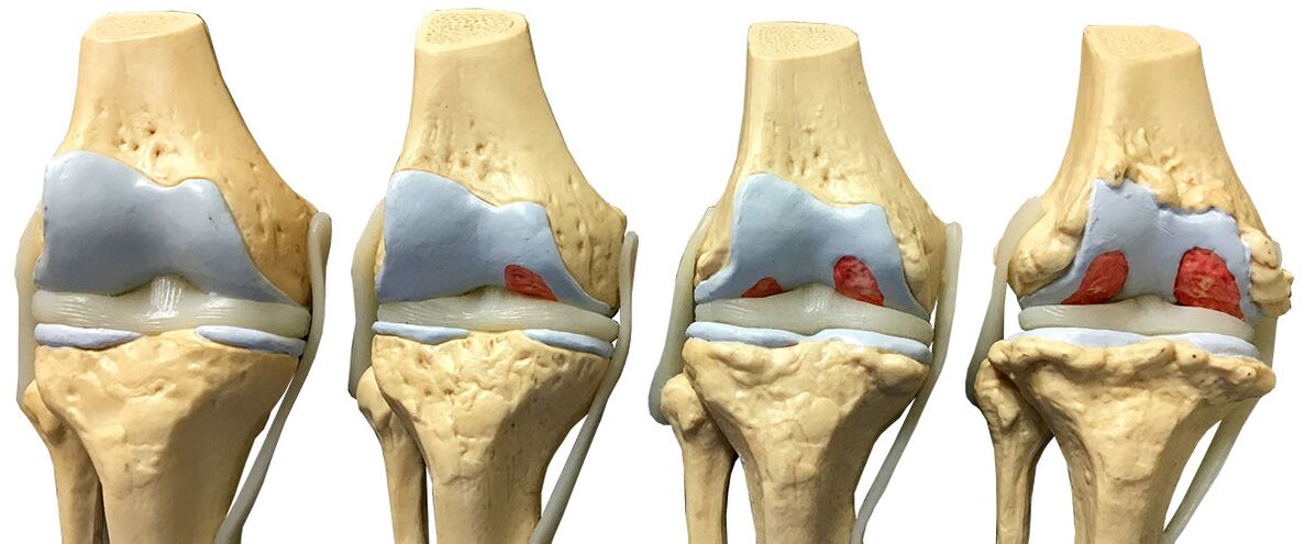 stages of osteoarthritis