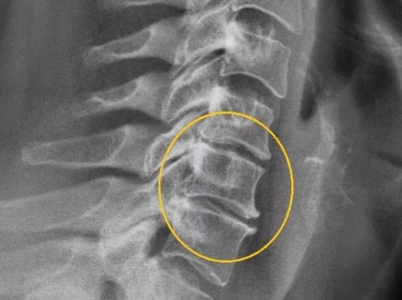 Osteochondrosis of the cervical spine on x-ray.